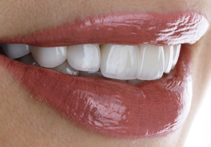 What Are Dental Veneers and How Do They Work?