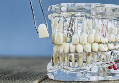 What Happens If You Don’t Replace a Missing Tooth?