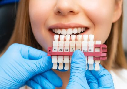 Professional Teeth Whitening vs At-Home Kits