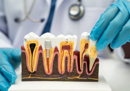 Root Canal vs Tooth Extraction, Here’s the Costs, Pros and Cons